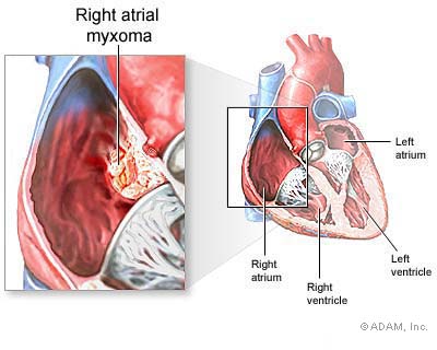 Ảnh 1 của Cardiac Tumors